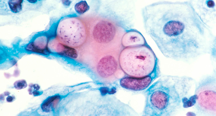 ქლამიდიოზი